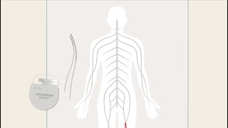 Boston Scientific - How SCS Works - Spanish