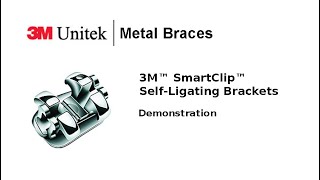 3M Unitek Metal Braces | www.bangkokbraces.com