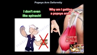 Popeye Arm Deformity - Everything You Need To Know - Dr. Nabil Ebraheim