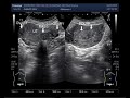 Ultrasound Video showing Uterine Polyp and a fibroid.