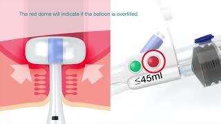 Flexi Seal™ PROTECT FMS   Fill Protection