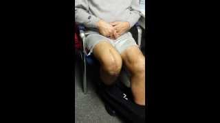 2 weeks after knee replacement by Dr Robert Lupo