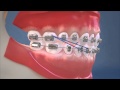 Class III Elastics - Lateral View (HD)