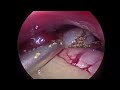 laparoscopic cholecystectomy feat dr. mayhew 1.13.23