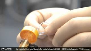 ConMed Linvatec Hitch Stitch using 2 8mm PopLok® Suture Anchor   Surgical Technique Video