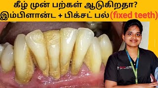 ஆடும் கீழ் முன் பற்கள்? இம்பிளான்ட் மூலம் பிக்சட் பல் ஒரே நாளில்  Fixed teeth with implants in tamil