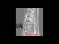 mri lumbar spine severe degeneration