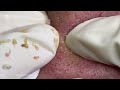 Big Cystic Acne Blackheads Extraction Blackheads & Milia, Whiteheads Removal Pimple Popping