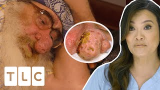 Patient Struggles To Breathe At Night With Hugely Overgrown Nose I Dr Pimple Popper