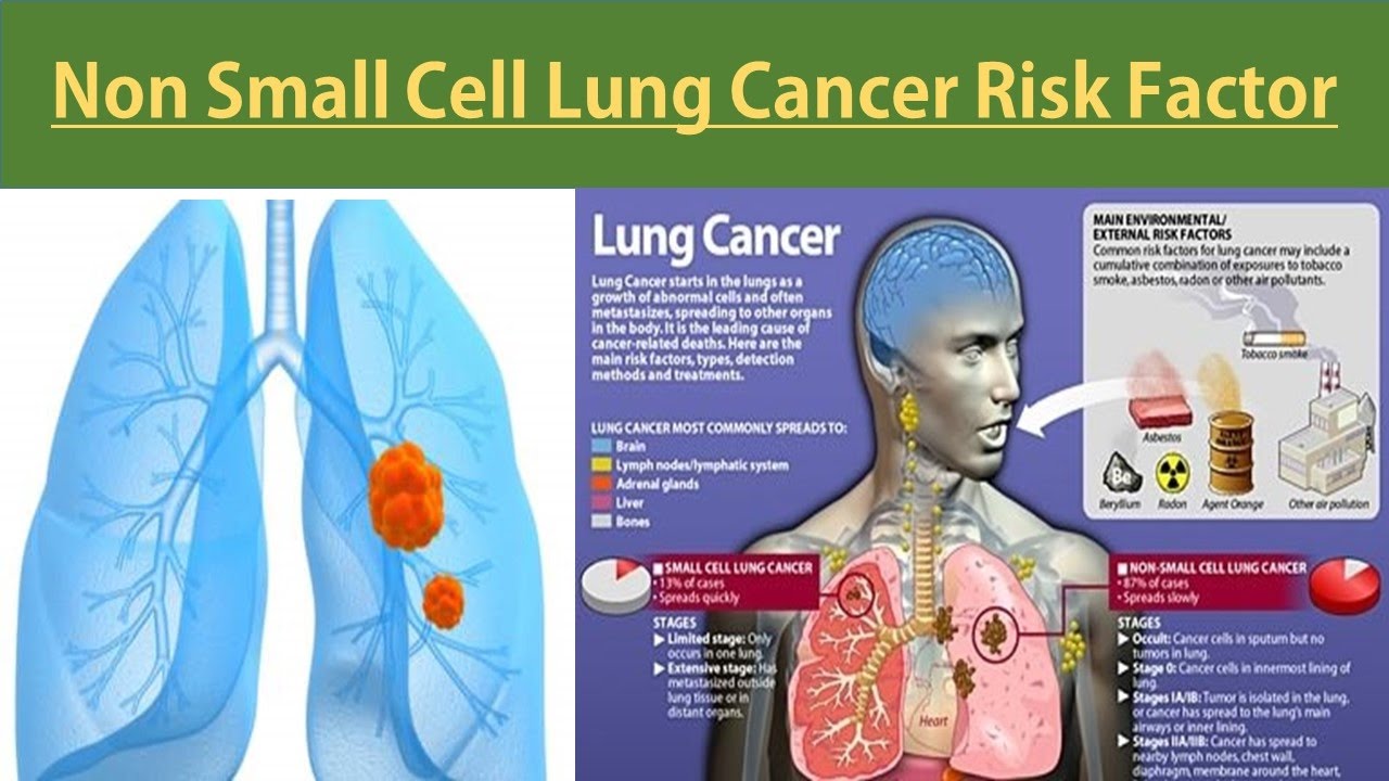 Non Small Cell Lung Cancer Risk Factor | Risk Factor Of NSCSL | What ...