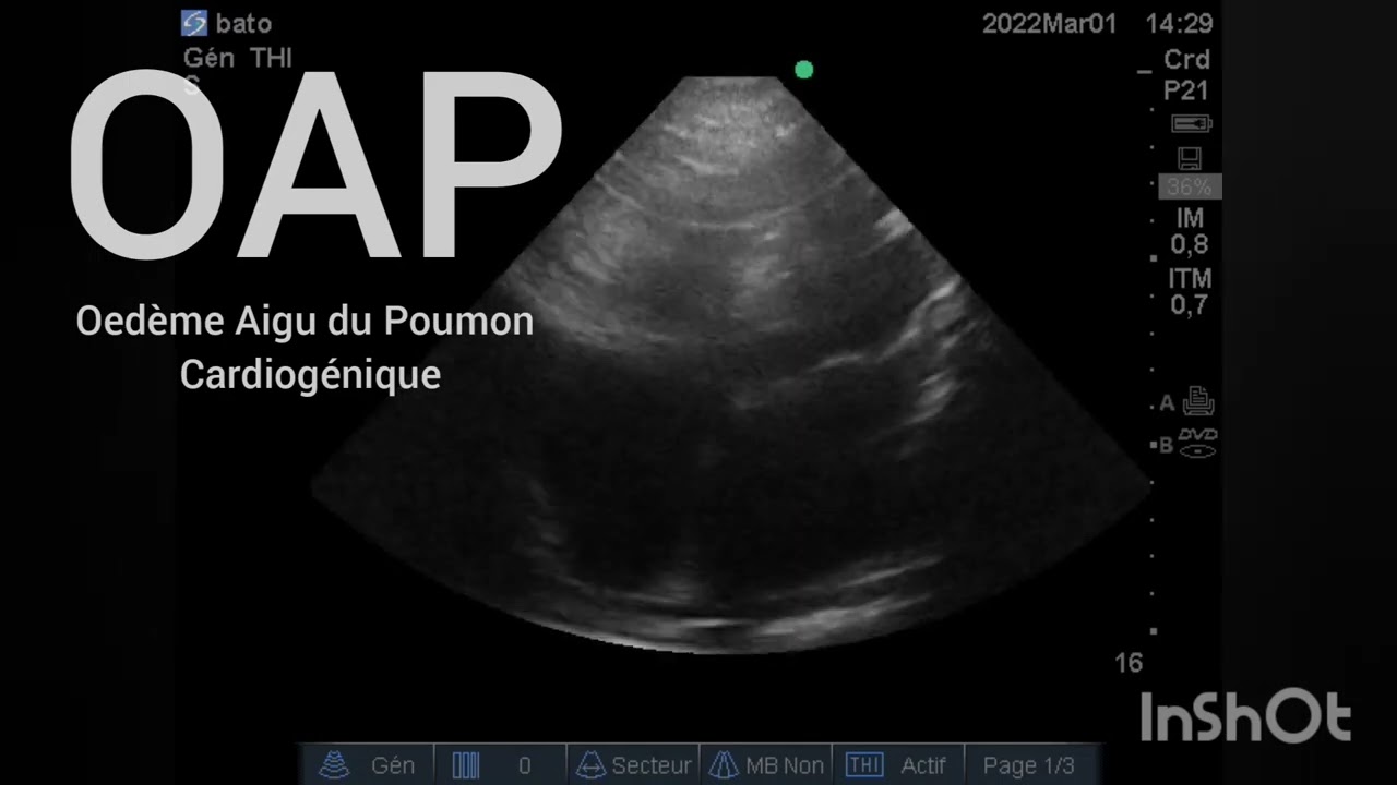 OAP Oedème Aigu Du Poumon Sur Insuffisance Cardiaque Gauche Chronique ...