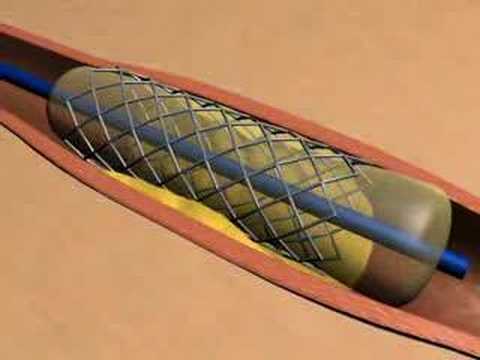 Stent Animation Youtube