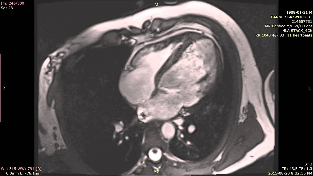 Mri Scan Heart