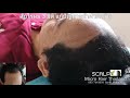 สักไรผม hairline แก้ไขปัญหาหน้าผาก็กว้าง by pafan beauty