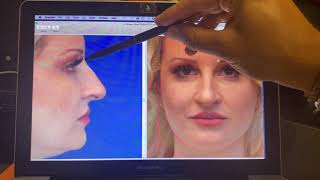 Nasal Analysis for Rhinoplasty with Dr. Jordan Rihani