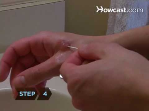 How to Treat Blisters How to Treat Blisters