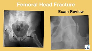 Femoral Head Fracture Exam Review - Bohannon Mason, MD