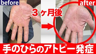 【手足の肌荒れ】汗疹から全身にアトピー症状。1年で改善しました。