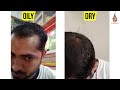 best hair regrowth treatment for men