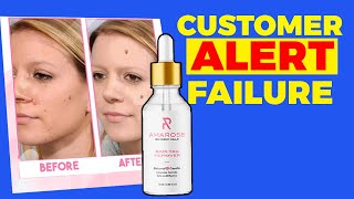 Amarose Skin Tag Remover⚠️CUSTOMER ALERT FAILURE ⚠️ Amarose review Amarose Skin Tag Remover Review