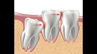 Fogászat 13.rész: Bölcsességfog, és foghúzás utáni teendők