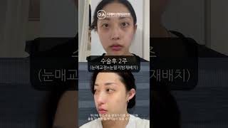 다크서클 없애는 법 눈매교정+눈밑지방재배치 후기