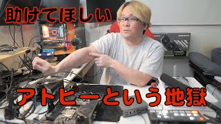 アトピー性皮膚炎という地獄、ステロイド依存、治療法はないのか