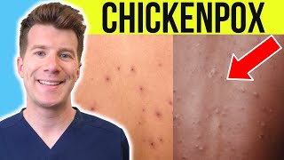 Doctor explains CHICKENPOX | Causes, Stages, Symptoms, Treatment (PLUS PHOTOS)