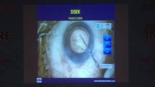 AIOC2019 GP078 Topic 7  DSEK û Technique and Complications     Dr Shreesh Kumar K