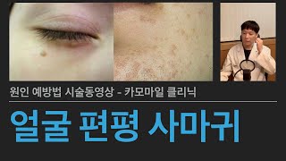 얼굴 편평사마귀 제거하기 - 인유두종 바이러스로 인한 피부 사마귀