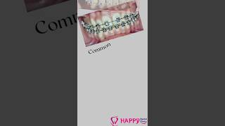 From ordinary to extraordinary : smile makeover with fashion braces. #braces #life #style #fashion