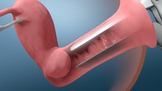 Pap Test