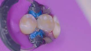 Single-Shade Bulk fill Restoration Using SimpliShade Bulk Fill | Dental Advisor \u0026 Dr. Sabiha Bunek