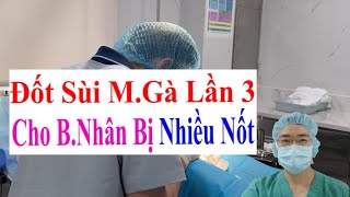 Chữa Bệnh Lý Sùi Mào Gà Lần Thứ 3 Cho B.Nhận Chủng Virus HPV Nặng | Bác Sĩ Sắc