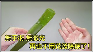 5种天然除痣方法，家裡也可以去痣！無手術，無激光，再也不用花錢除痣了！ （民間偏方）