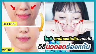 How to get rid of nasolabial folds, fade and soften smile lines and cheek lines without filler.