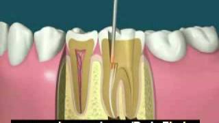 طريقه قطع العصب