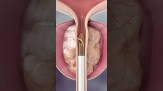 പ്രോസ്റ്റേറ്റ് വീക്കത്തിന് പുതിയ ചികിത്സ. ഇനി ഓപ്പറേഷൻ വേണ്ട!  Rezūm Water Vapor Therapy