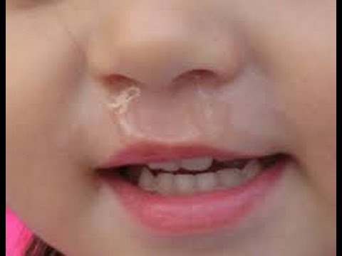 How to Soothe a Sore and Irritated Nose After Frequent Blowing How to Soothe a Sore and Irritated Nose After Frequent Blowing