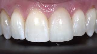 Chew \u0026 Smile like a Pro!Tooth replacement by a Dental Implant. @dr.davidmazza6631