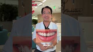 There are 5 main types of braces 😬 #orthodontist #orthotips #braces