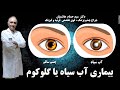 بیماری آب سیاه یا گلوکوم و درمان آن ، فوق تخصص قرنیه دکتر سید حسام هاشمیان