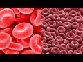 What is Anemia of Malignancy? Causes, Treatment