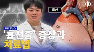 흉선종 240217ㅣTBC뉴스