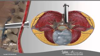 Lumbar Microdiscectomy - Spine Center Northern Nevada, Northern California - Spi