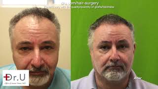 Dr.U’s Budget Friendly FUE Hairline Restoration  With Just 1200 Grafts