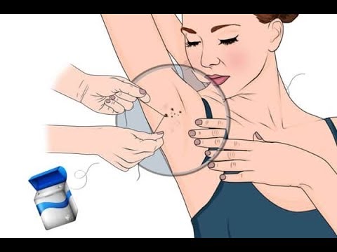 How to Get Rid of Skin Tags on Armpits How to Get Rid of Skin Tags on Armpits