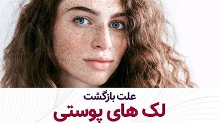 علت بازگشت لک های پوستی | لک های پوستی و علت ایجاد آن ها در بدن و صورت