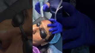 Q-switched Nd:YAG laser for Pigmentation #Pigmentation #skincare #shorts #drthajlifestyle