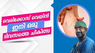 വെരികോസ് വെയ്ൻ ഇനി ഒരു ദിവസത്തെ ചികിത്സ What is Varicose | Best Treatment for Varicose Veins